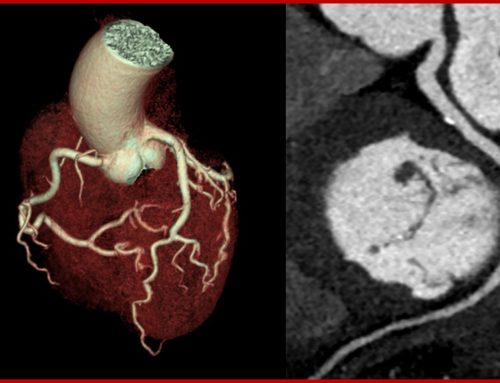 Cardiopatia ischemica: utilità della TAC cardiaca