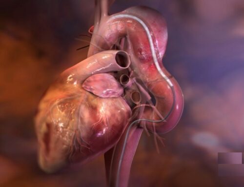 Patologie dell’aorta, l’arteria principale del nostro corpo